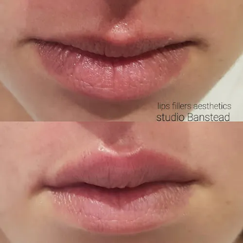 1 - Aesthetics Studio&Botox, Dermal Fillers, Microblading Eyebrows.