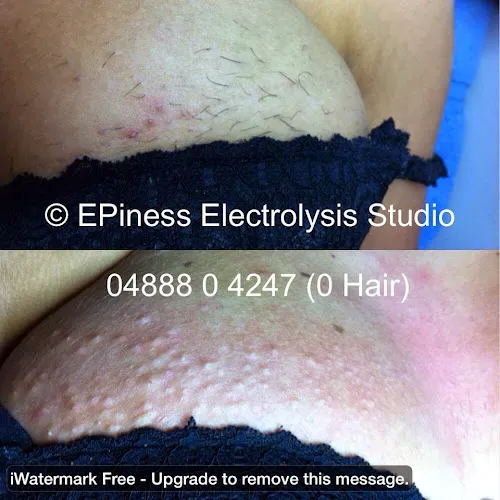 3 - EPIness Electrolysis Studio