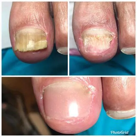 5 - Toe Thaise massage